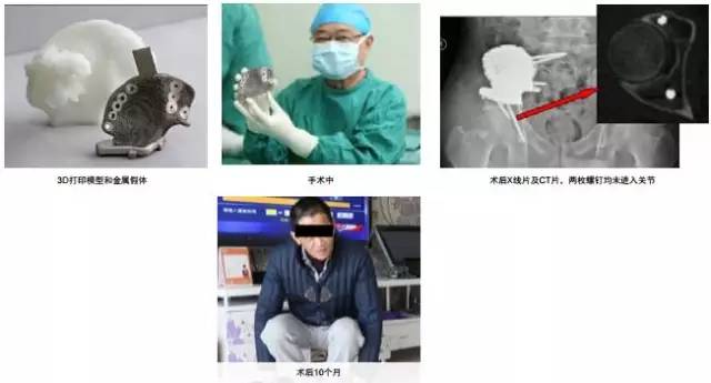 3d打印在醫療領域的應用 3D打印與醫療行業白皮書